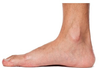 Tarsal coalition often presents with flat feet. Find out about the causes, symptoms and treatment options. Tarsal coalition often presents with flat feet. Find out about the causes, symptoms and treatment options.