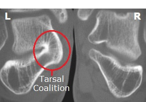 The abnormal joining of tarsal bones known as Tarsal Coalition can cause foot pain