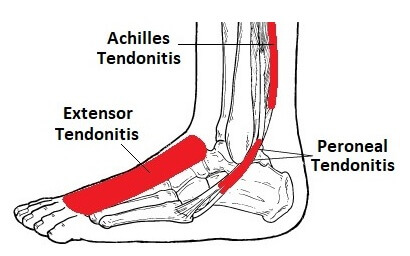 Heel pain sales especially in morning
