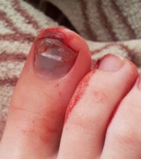 Tennis Toe Subungual Hematoma Symptoms Treatment