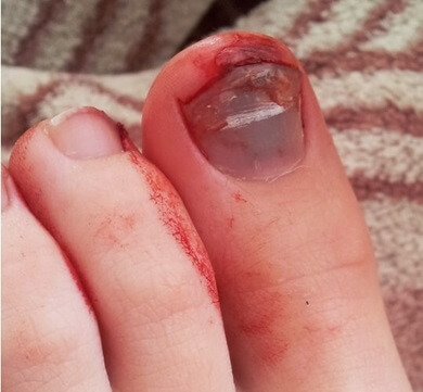 Tennis Toe is a common cause of toe pain with blood pooling under the nail