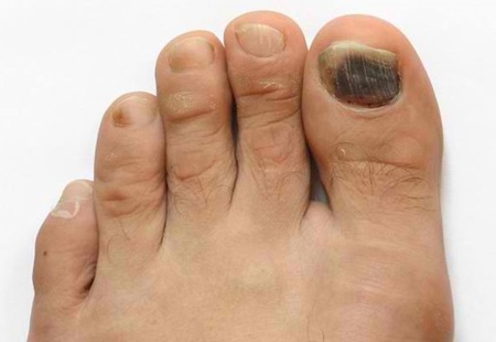 tennis toe 450 opt jan 26