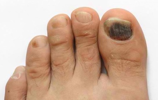 I've got a small haematoma under a nail I hit in a door. I had it for 2  months. Will it eventually go away? - Quora