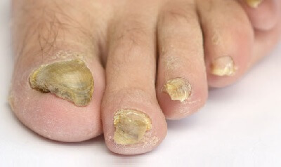 How To Soften Thick Toenails - Toenail fungus Treatment Center