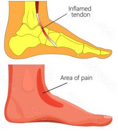 Living with Chronic Foot Pain - Sarah Hearts