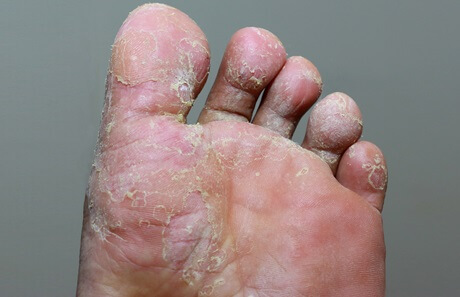 Tinea Pedis: Symptoms, causes and treatment for Athlete's Foot Tinea Pedis: Symptoms, causes and treatment for Athlete's Foot