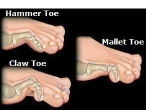 Hammer, Mallet and Claw Toe result in the toe sitting in an abnormal position. Find out about the common causes, symptoms, diagnosis & treatment options