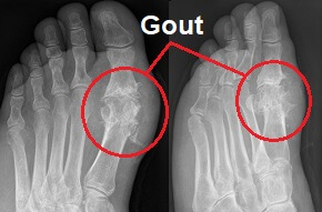 Foot Gout & Podagra: Prevention, Diagnosis & Treatment