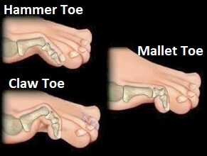 Les orteils en griffe, en maillet et en marteau sont des causes fréquentes de douleurs articulaires aux orteils