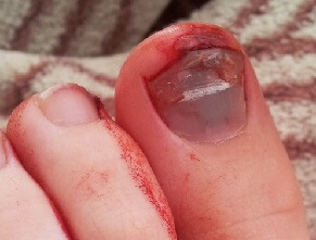 Tennis Toe is a common cause of toe pain with blood pooling under the nail