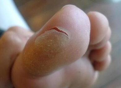 toe pain blister 390 opt oct 23