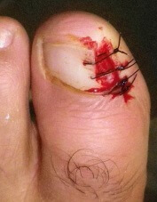 Toe nail removal for a haematoma