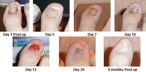 TOP 10 BEST Ingrown Toenail Removal near Encinitas, CA - October