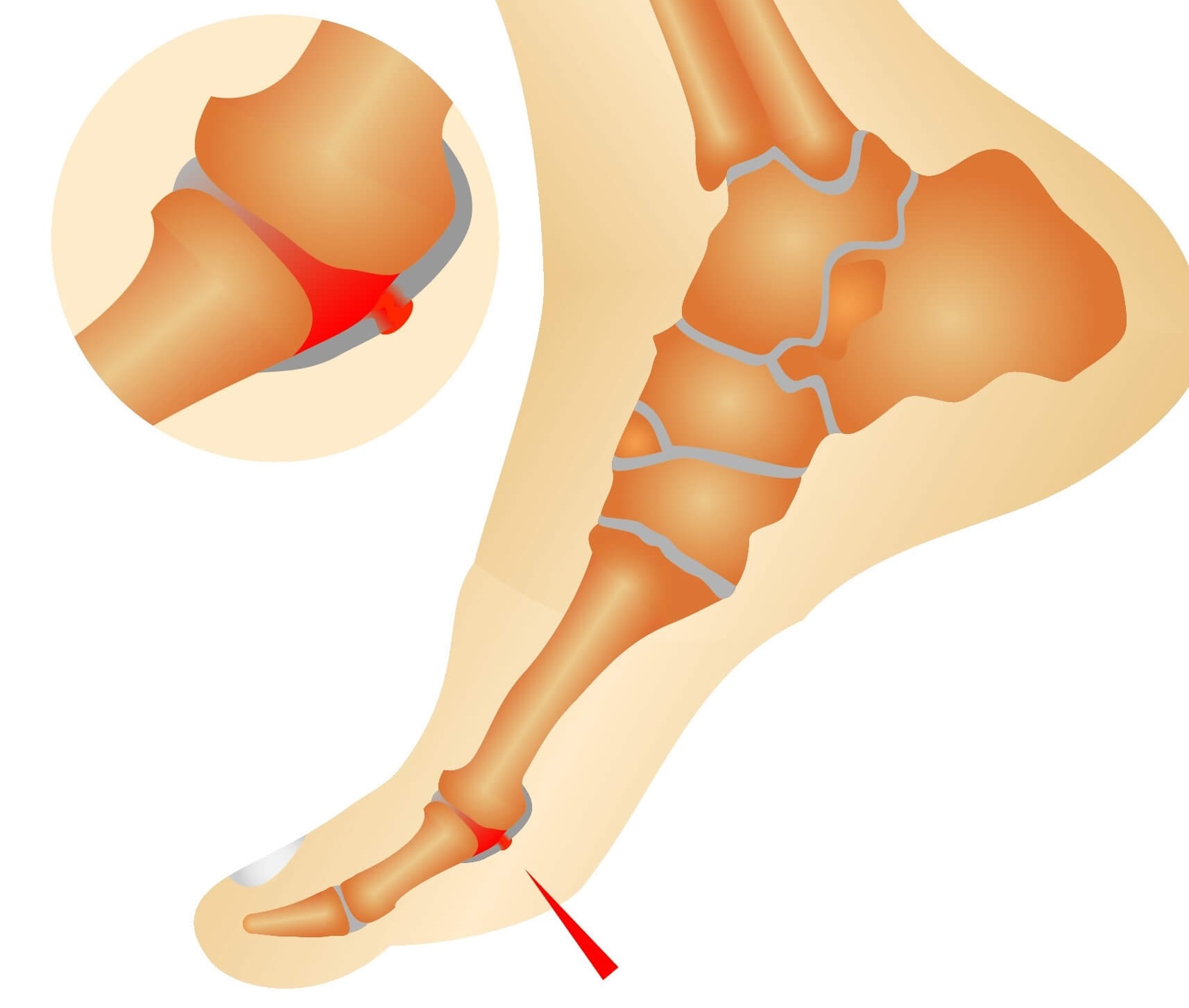 Turf toe is a common sporting injury when the big toe bends back too far, causing pain in the big toe joint Turf toe is a common sporting injury when the big toe bends back too far, causing pain in the big toe joint