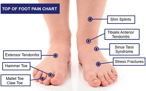Top Of Foot Pain Diagram: Common causes of pain on top of foot chart Top Of Foot Pain Diagram: Common causes of pain on top of foot chart