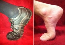 Turf Toe is usually caused by hyperextension of the big toe