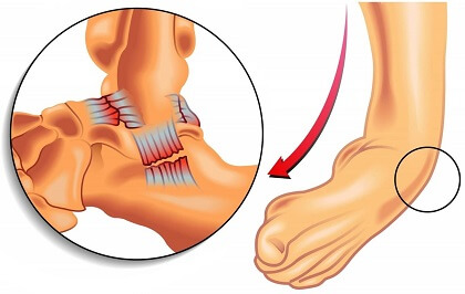 Twisted Ankle: Symptoms, Diagnosis 