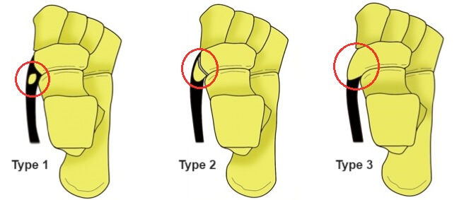 Say Goodbye To Accessory Navicular Pain The Ultimate Shoe Guide - coctprq