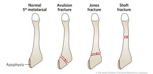 Different Types Of Fifth Metatarsal Fractures: Symptoms, causes, diagnosis and treatment