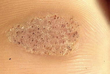 A classic feature of plantar warts, aka verruca vulgaris, are small black dots. These are dried, clotted blood vessels A classic feature of plantar warts, aka verruca vulgaris, are small black dots. These are dried, clotted blood vessels