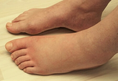 Why Are My Feet Swollen Foot Pain Explored