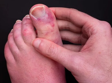 Why Is My Foot Red? Vascular problems affect the circulation to and from the foot which can cause red spots on feet