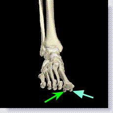 Inflammation of the sesamoid bones and surrounding tendons underneath the big toe are a common cause of sore toes