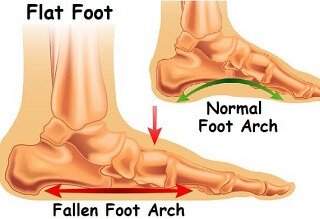 posterior tibial tendonitis foot pain explored posterior tibial tendon dysfunction