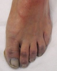 clot waffle on foot