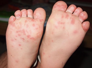 white bump on bottom of foot Fat thick boob vidos