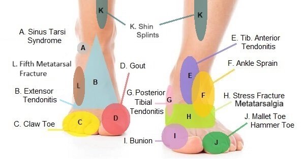 Front and Top of Foot Pain Interactive Map