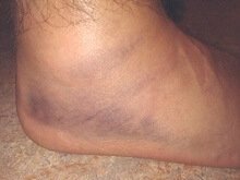 A severely sprained ankle will result in immediate swelling of the foot and ankle due to bleeding into the joint A severely sprained ankle will result in immediate swelling of the foot and ankle due to bleeding into the joint