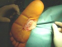 lump on bottom of foot Lump on bottom of foot