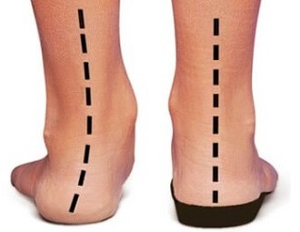 Orthotics to correct adult flat foot deformity Orthotics to correct adult flat foot deformity