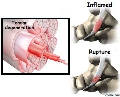 posterior tibial tendonitis foot pain explored posterior tibial tendon dysfunction