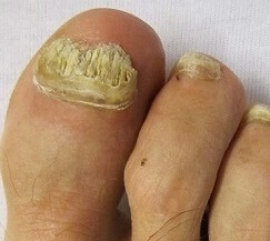 Thick Toenails: Pictures, Causes, and Home Treatments