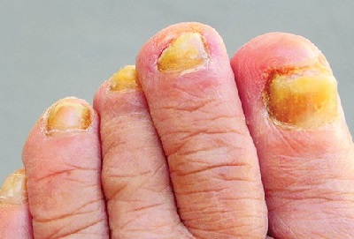 Yellow Toenails: Causes & Treatment - Foot Pain Explored